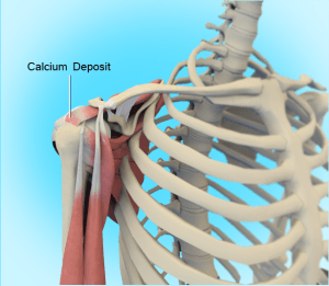 Calcium Tendinitis